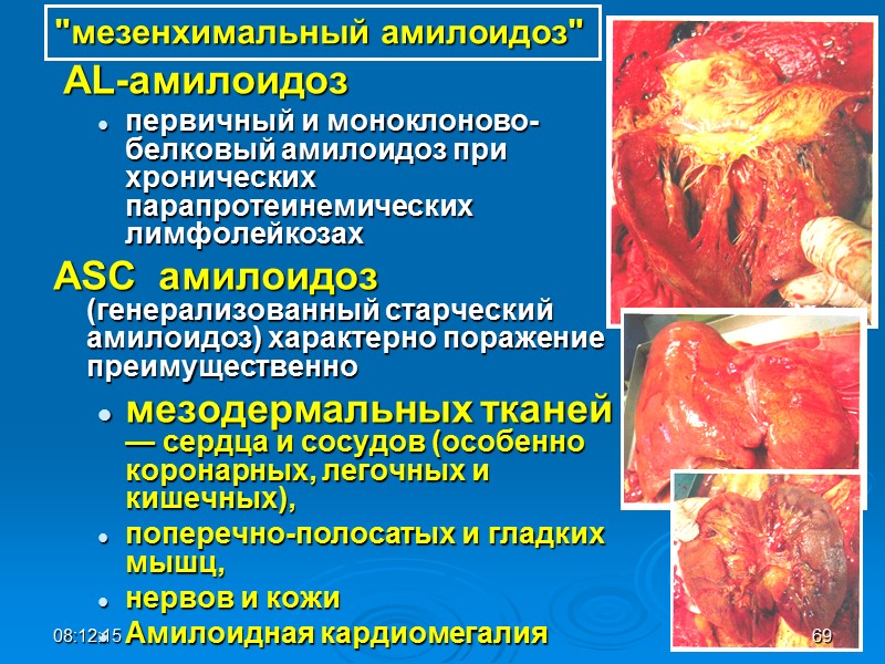 AL-амилоидоз первичный и моноклоново-белковый амилоидоз при хронических парапротеинемических лимфолейкозах  АSС  амилоидоз (генерализованный